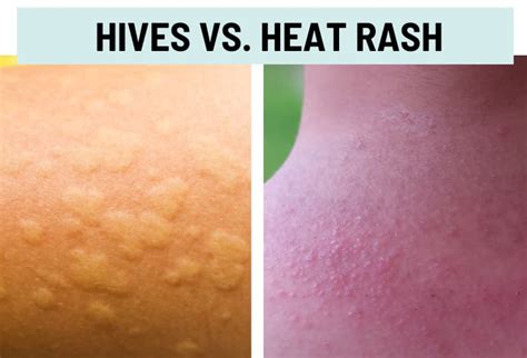 Hives Urticaria Vs Rash Pictures And Differences