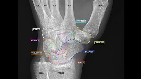 Lateral Wrist X Ray Labeled