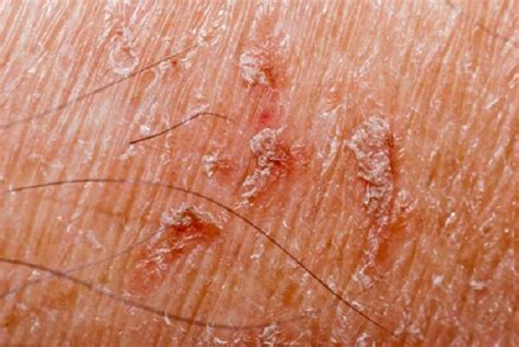 Dry Scaly Spots On Skin
