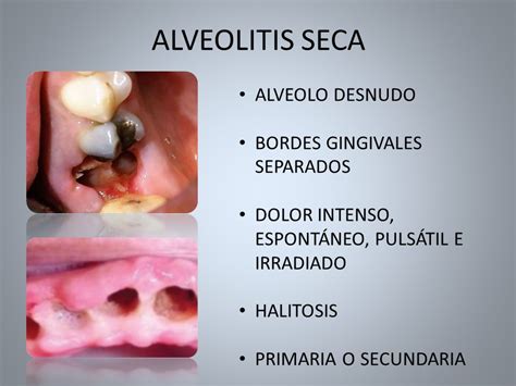 Encuentro Provincial De Residentes De OdontologÍa Higa Gral San MartÍn De La Plata Alveolitis