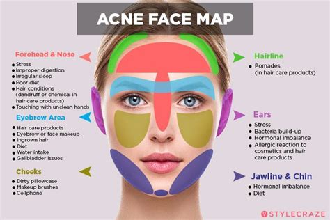 Acne Face Map What Your Breakouts Are Trying To Tell You