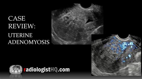 Case Review Ultrasound Of Uterine Adenomyosis Youtube