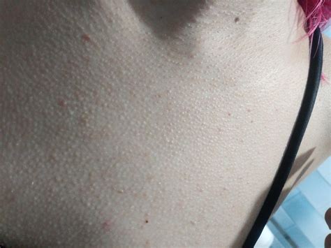 Skin Concerns My Skin Looks Like Chicken Skin On My Chest Neck And