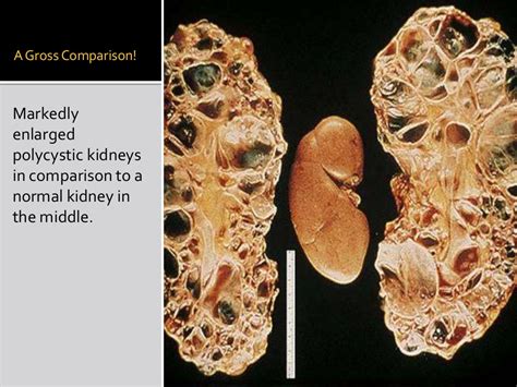 Autosomal Dominant Polycystic Kidney Disease Adpkd