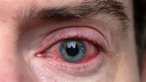 Psoriatic Arthritis And Eye Problems Everyday Health