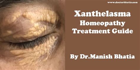Xanthelasma Homeopathy Treatment And Homeopathic Remedies Doctor
