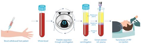 How Platelet Rich Plasma Treatment Work Esco Scientific