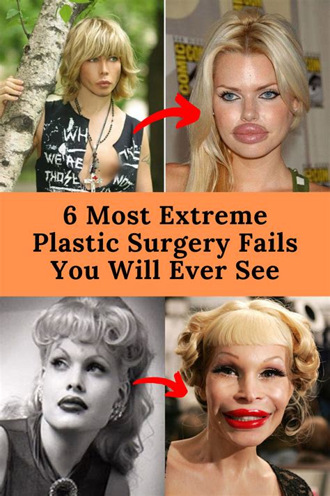 6 Most Extreme Plastic Surgery Fails You Will Ever See Celebrity
