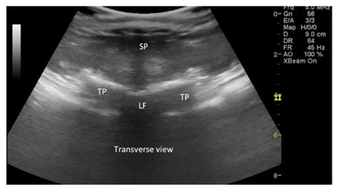 The Use Of Ultrasound To Measure The Depth Of Thoracic Epidural Space