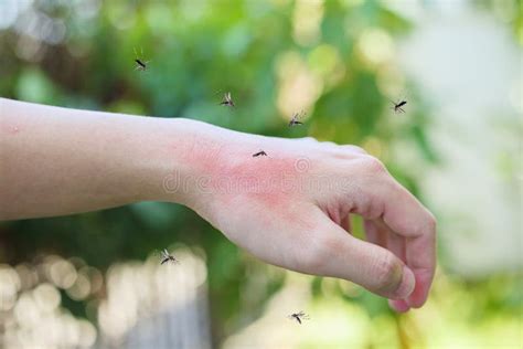 Mosquitoes Bite On Adult Hand Made Skin Rash And Allergy Stock Image