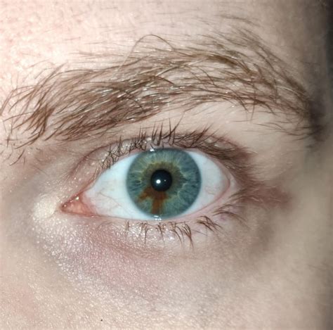 My Left Eye Has Sectoral Heterochromia Rheterochromia