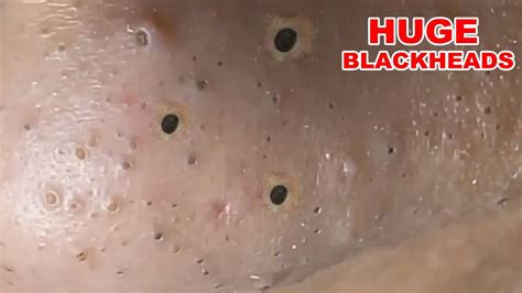 Blackheads Extraction On The Nose Part Youtube