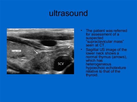 Thymus Gland Fetal Ultrasound
