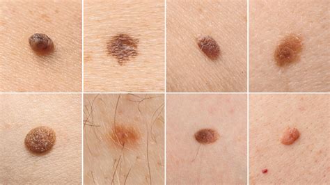 Understanding The Different Types Of Moles Spot Check Clinic