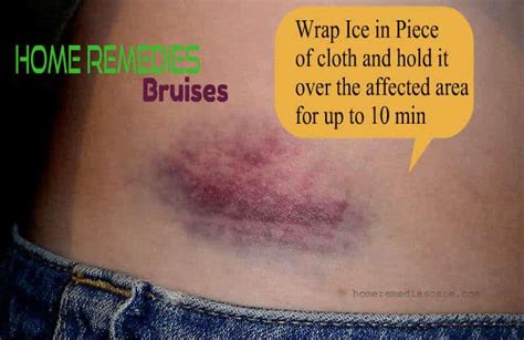 18 Amazing Home Remedies To Get Rid Of Bruises Fast