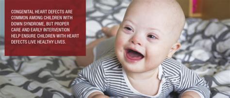 Congenital Heart Defects And Down Syndromewhat Parents Should Know