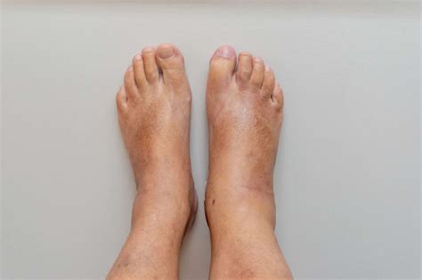 دلایل ورم پا یا ورم مچ پا چه زمان ورم پا نشانه یک بیماری جدی است؟ پیتونیک