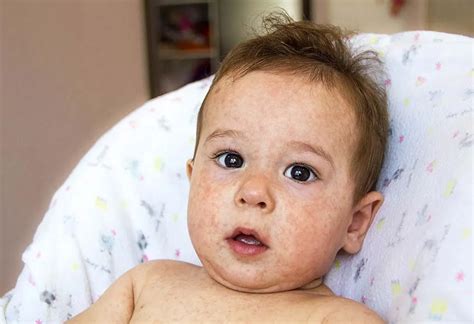 Skin Discoloration In Babies Causes And Home Remedies
