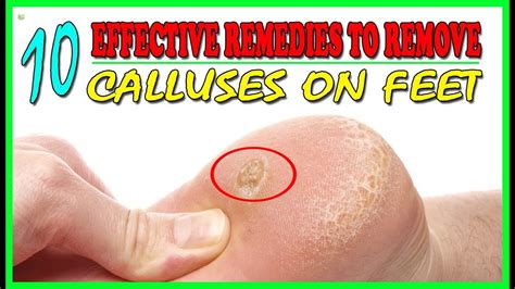 10 Effective Home Remedies To Remove Calluses On Feet Callus Removal