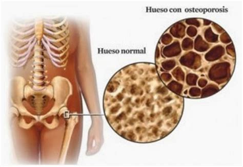 Tendencias En El Tratamiento De La Osteoporosis La Terapia Secuencial Clínica Reumatológica
