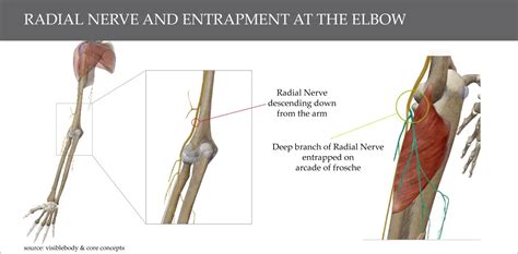 Its Seems Tennis Elbow But Its Not Its Radial Tunnel Syndrome