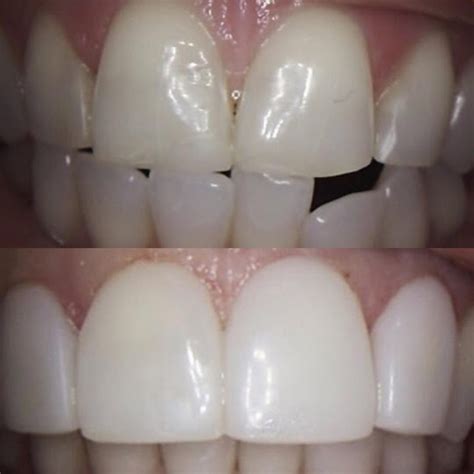 New Cases Of Our Happy Patients Los Altos Dental Excellence