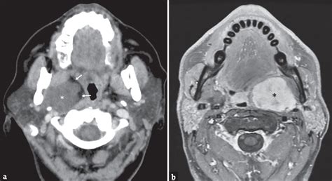 Crosssectional Imaging Of Parotid Gland Nodules A Brief Practical