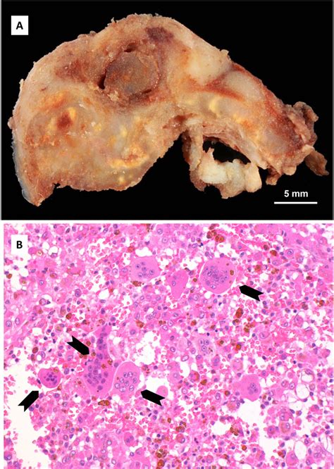 Tenosynovial Diffuse Type Giant Cell Tumor Of The Temporomandibular