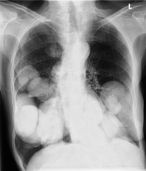 Cannonball Metastases Cxr Radiology At St Vincents University