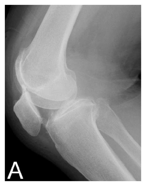 Intraoperative Findings Osteophyte Is Apparent On The Superior Pole Of
