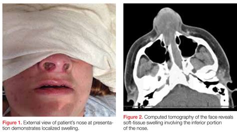 Case Report Nasal Septal Abscess Clinician Reviews