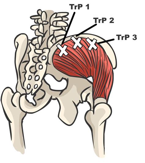 Gluteus Medius Bilspier Triggerpoint Reset Methode