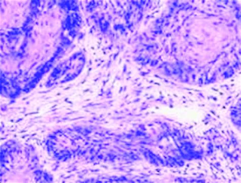 Photomicrograph Showing Palisading Pattern Of Peripheral Cells In Tumor
