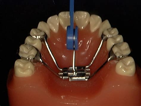 Biggs Hansen Orthodontics Smiles Above The Rest Rapid Palatal Expander