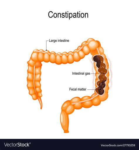 Constipation Human Large Intestine With Fecal Vector Image