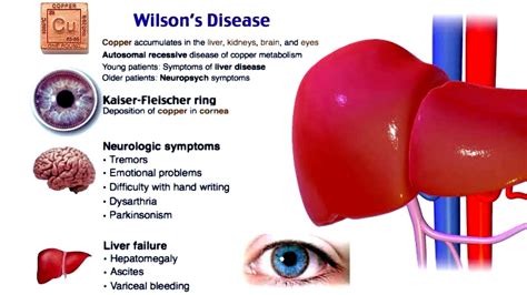 Wilson Disease Symptoms Causes Medicines Homeopathic Treatment