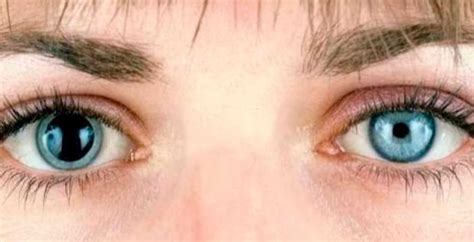 Simetria Das Pupilas E O Diagnóstico De Doenças Oculares Ioa