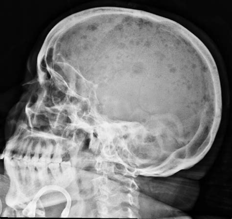 Skull Xray Causes Symptoms Treatment Skull Xray
