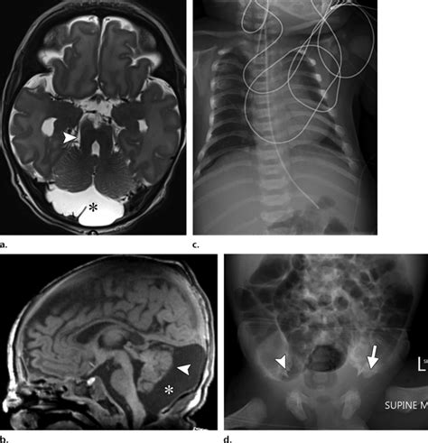 Overlapping Features Of Joubert And Jeune Syndromes In A Newborn With