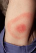 Look Out For Lyme Disease This Summer - Golf Blog | RockBottomGolf.com