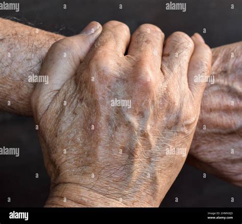 Senile Spots Hi Res Stock Photography And Images Alamy