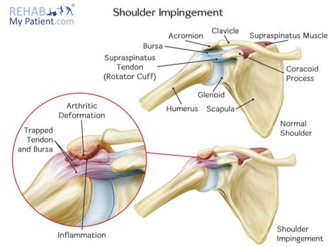 What Is A Shoulder Impingement Westcoast Sci Physiotherapy