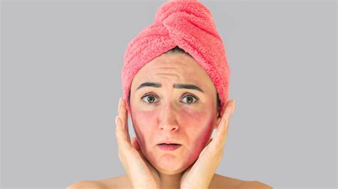 Milialar Skin Disease Understanding The Irritating Rash Tumgazeteler