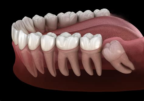 Impacted Wisdom Teeth Flowood Ms Oral And Facial Surgery Of Mississippi