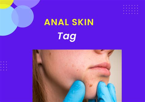 Anal Skin Tag Causes Removal Recovery