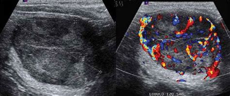 Papillary Thyroid Cancer Ultrasound Colors Pillar Of Society Bloggers