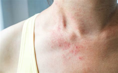 A New Symptom Of Coronavirus Appeared Skin Rash Somag News