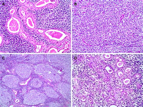 Diffuse Large B Cell Lymphoma Arising From Follicular Lymphoma With