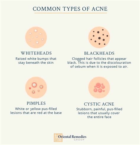 Understanding And Treating Acne Maskne Back Acne The Tcm Way