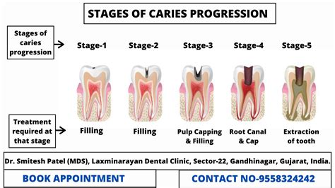 Tooth Decay Stages And How To Treat Each Laxmi Narayan
